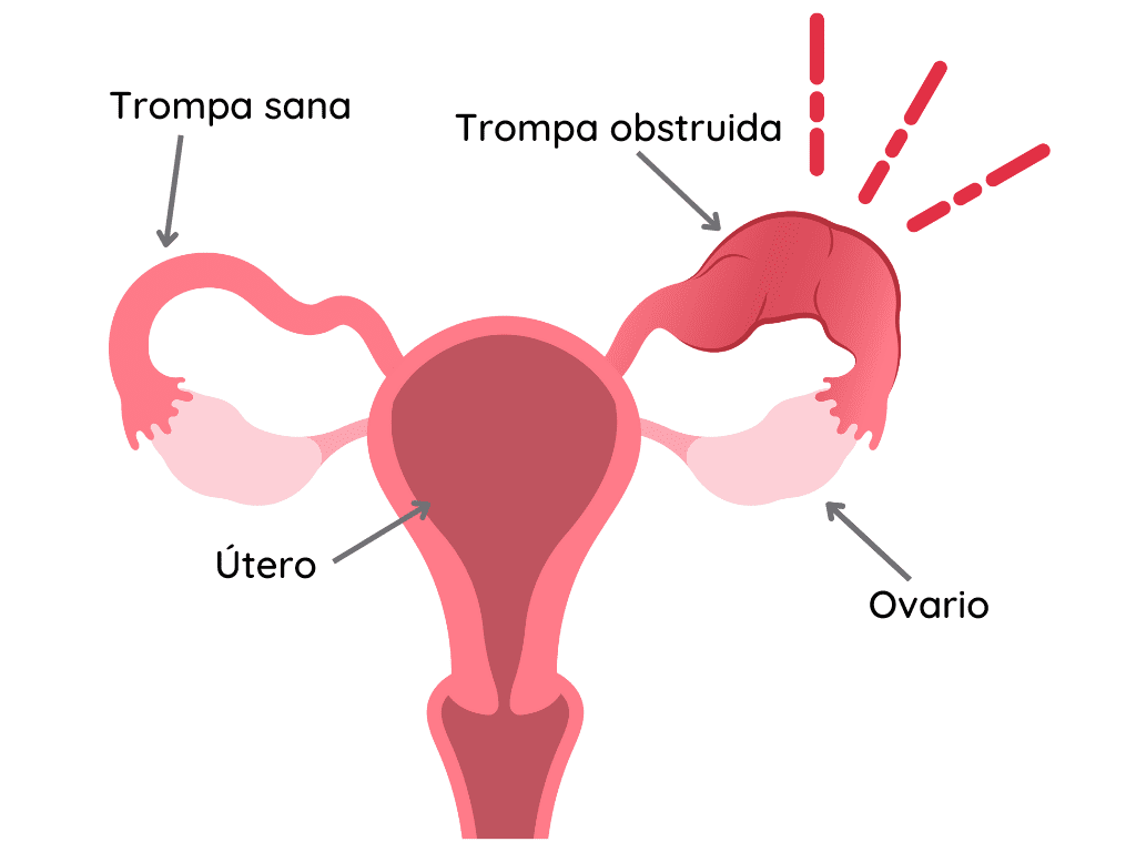 Diagrama De Las Trompas De Falopio